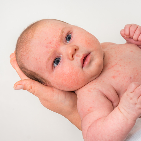 Image of baby with eczema rash on face and body
