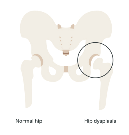 What Developmental Dysplasia of the hip (DDH), or ‘hip dysplasia’, looks like vs. normal hip